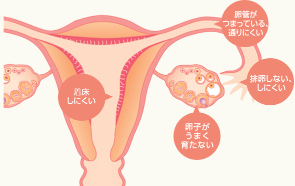 女性の原因のイラスト