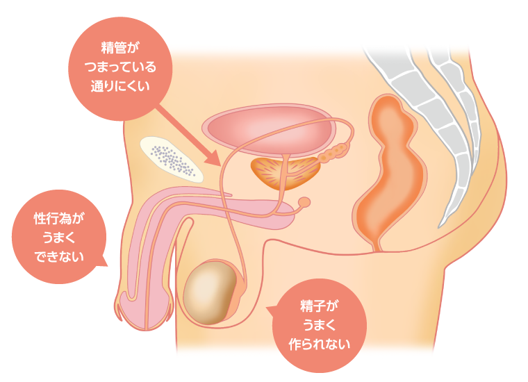 男性の原因のイラスト